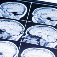 BrainInj3 BrainInj3